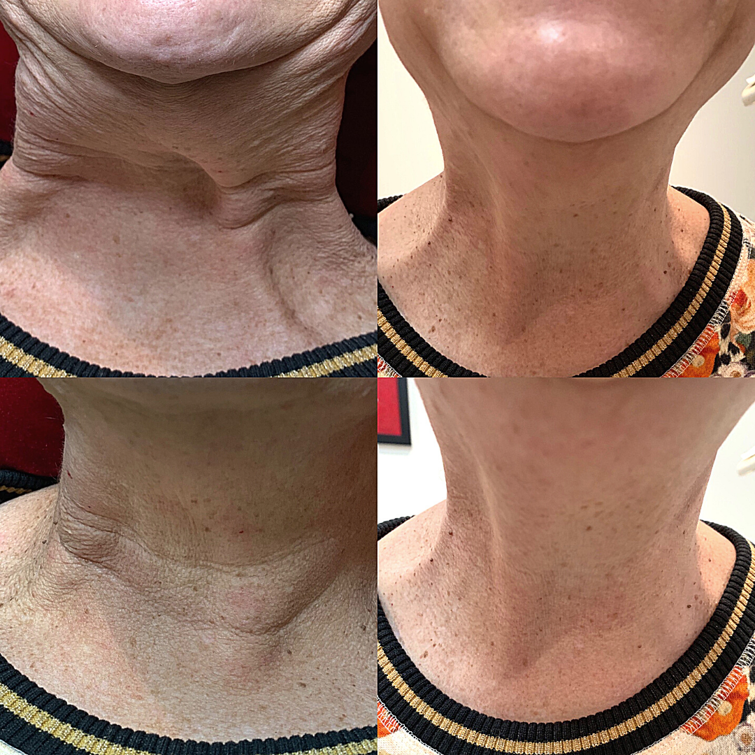 Anti-Wrinkle Injections Appointment